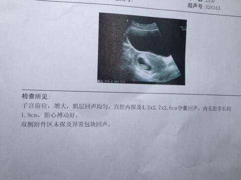 做试管遭遇三次胎停 广州坤和成功助孕