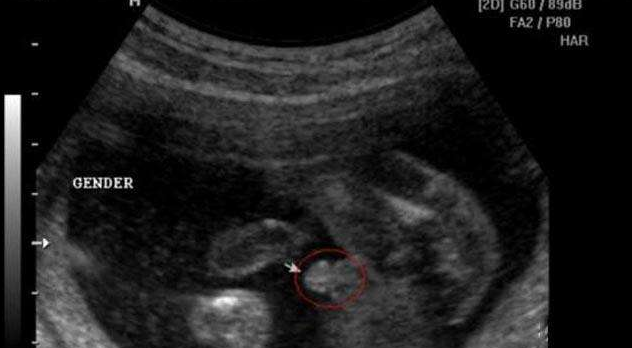卵巢早衰致不孕，广州坤和试管一举怀上男宝
