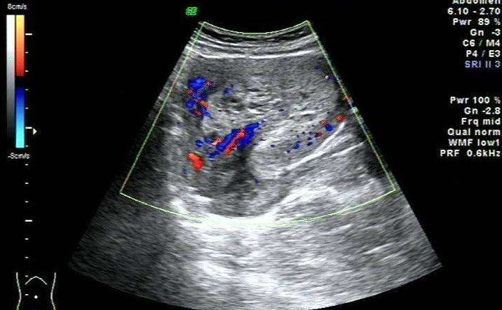 子宫内膜厚度对试管婴儿有哪些影响